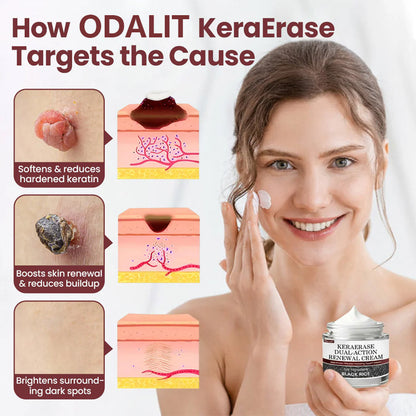 ✅Flash Sale - ODALIT®KeraErase Dual-Action Renewal Cream