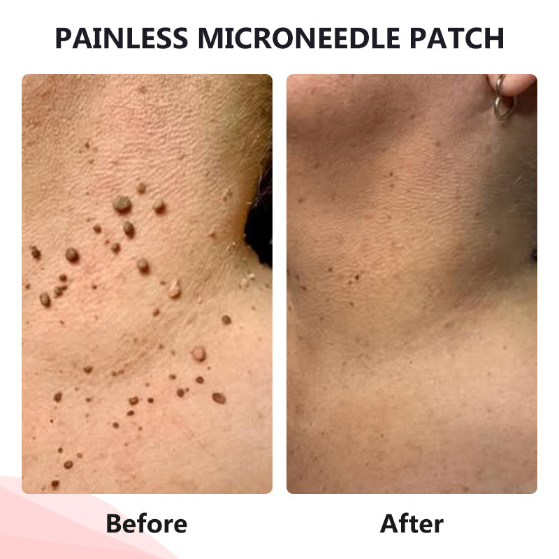 🔥ODALIT™ painless micro-patch🔥