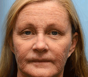 [🥇Last Day 70% OFF] ODALIT™ Botox & Retinol Shot - Eraser for Deep Wrinkles, Sagging Jowls & Puffy Eyes