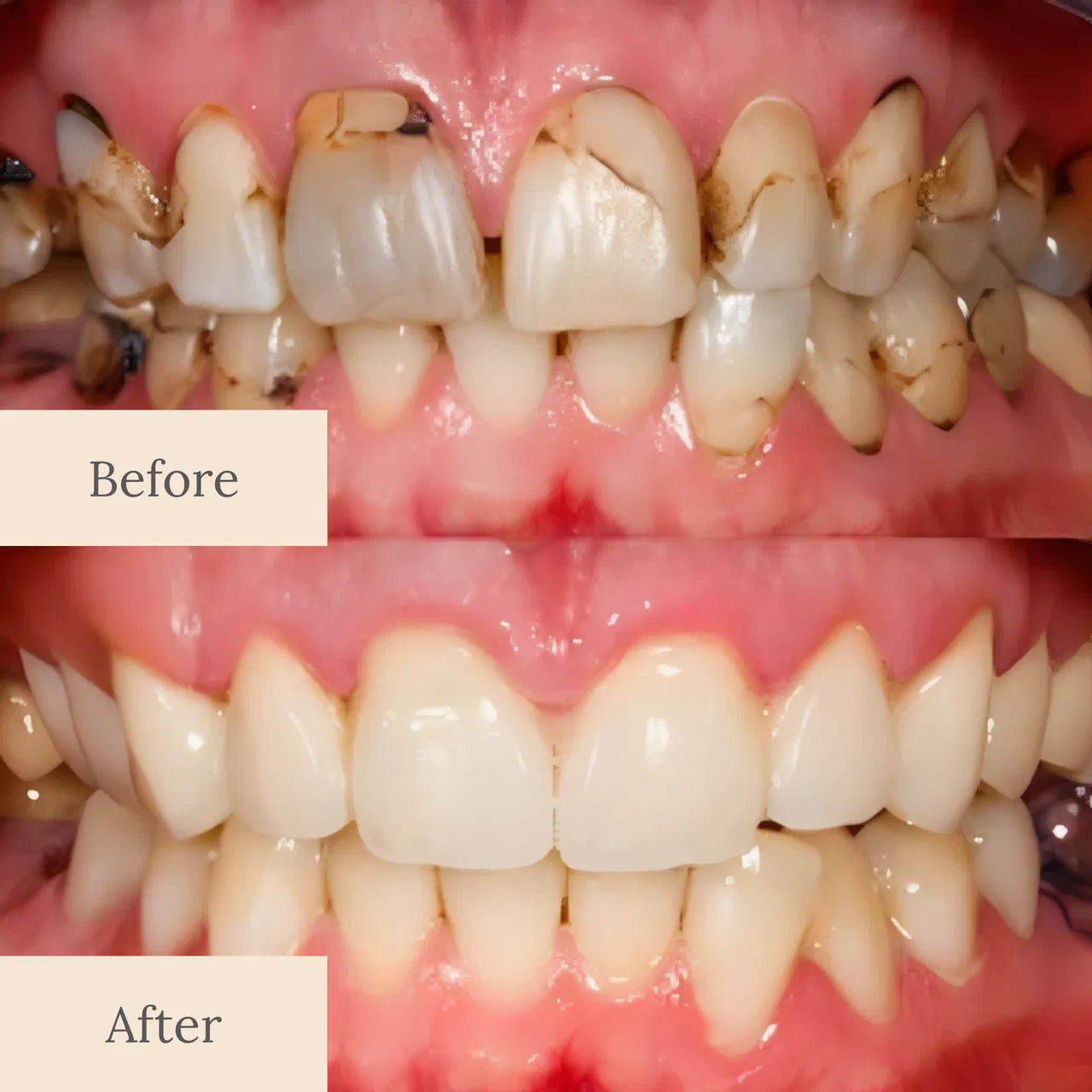 LBMLBM™ Teeth Armor Drops